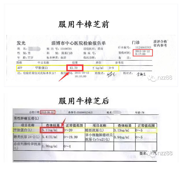 牛樟芝治疗晚期肝癌临床实验