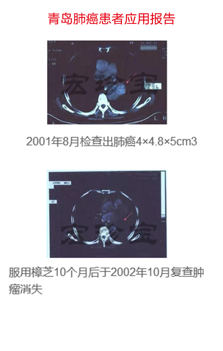 牛樟芝治肺癌